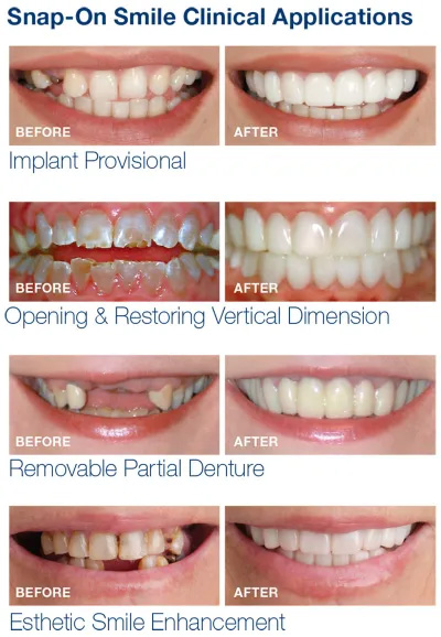 clip on veneers reviews