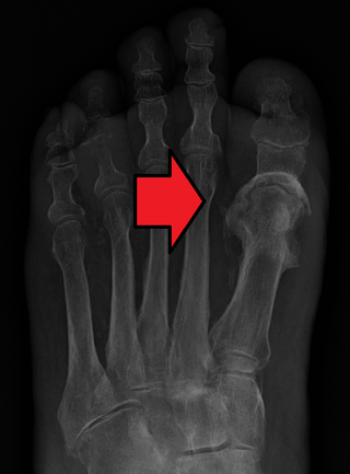 osteomyelitis meaning in tamil