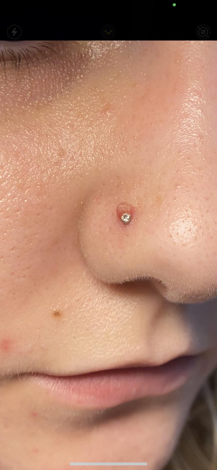 nose piercing keloid