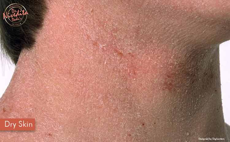 thyroid skin rash pictures face