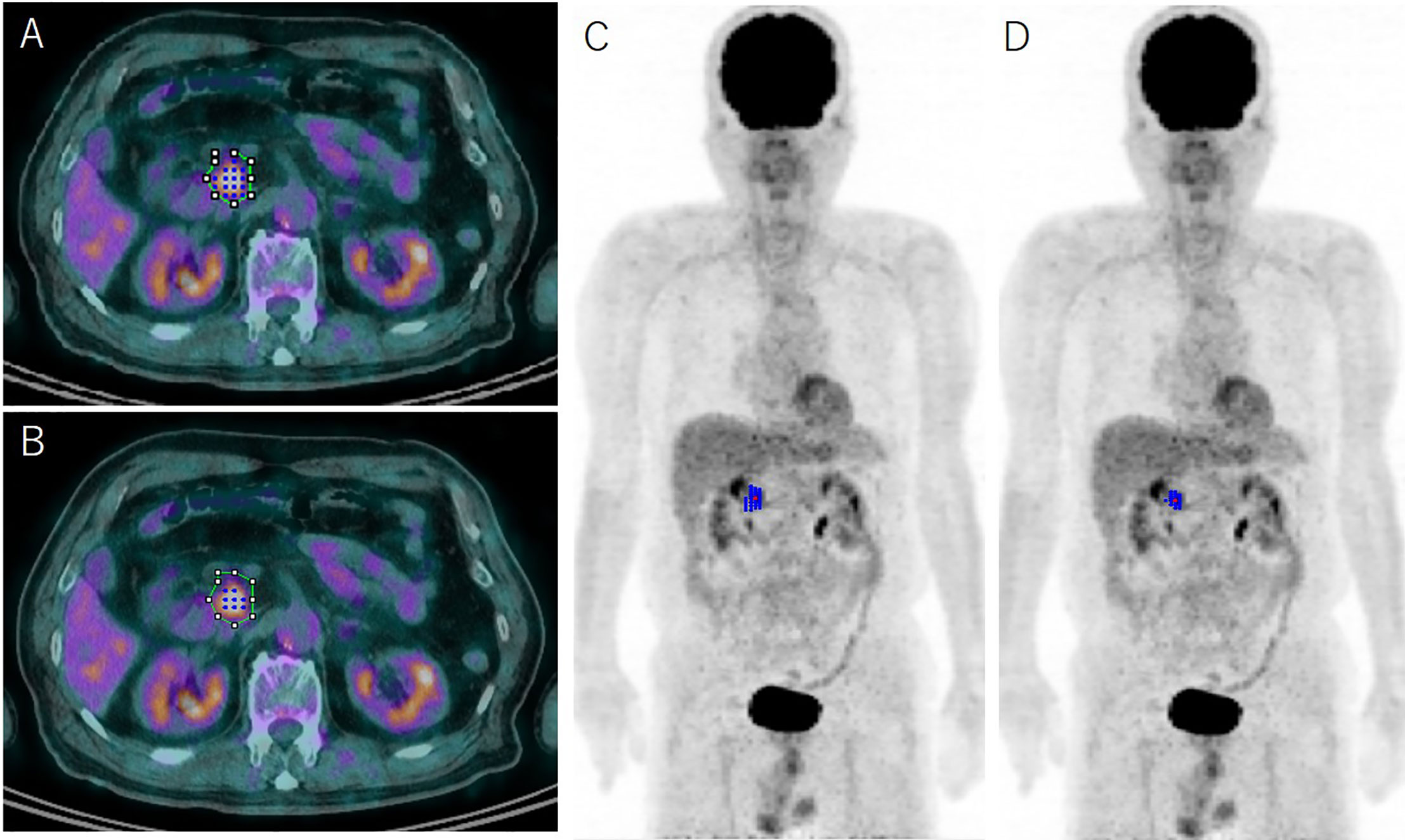 fluorodeoxyglucose positron emission tomography