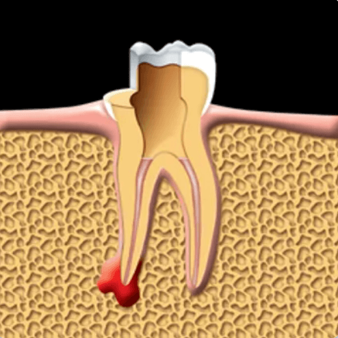 dental root canals treatment maple ridge