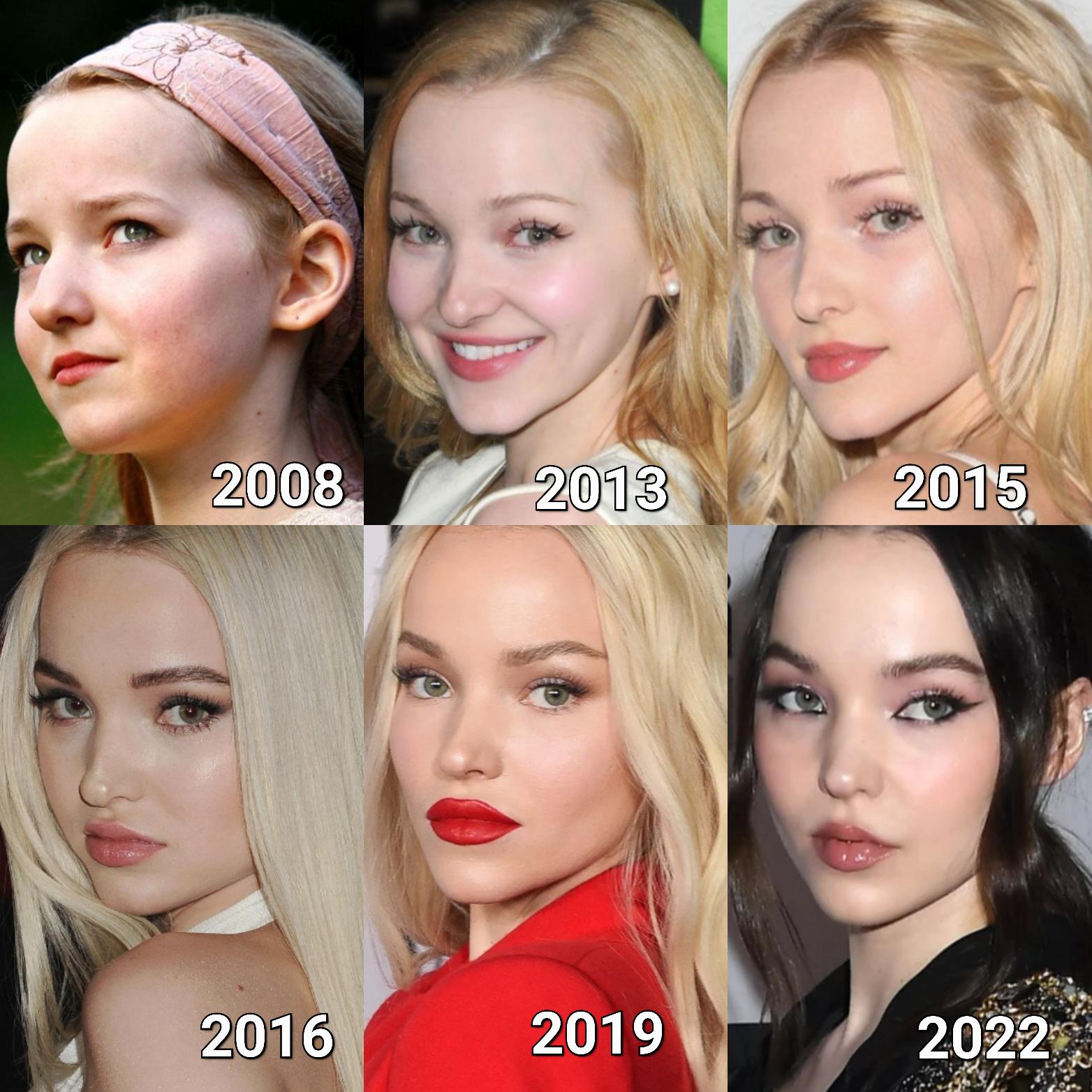 dove cameron plastic surgery