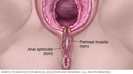 3rd degree perineal tear pictures