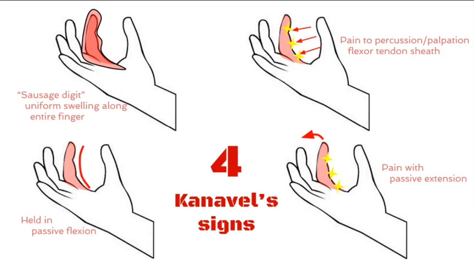 flexor tenosynovitis icd 10