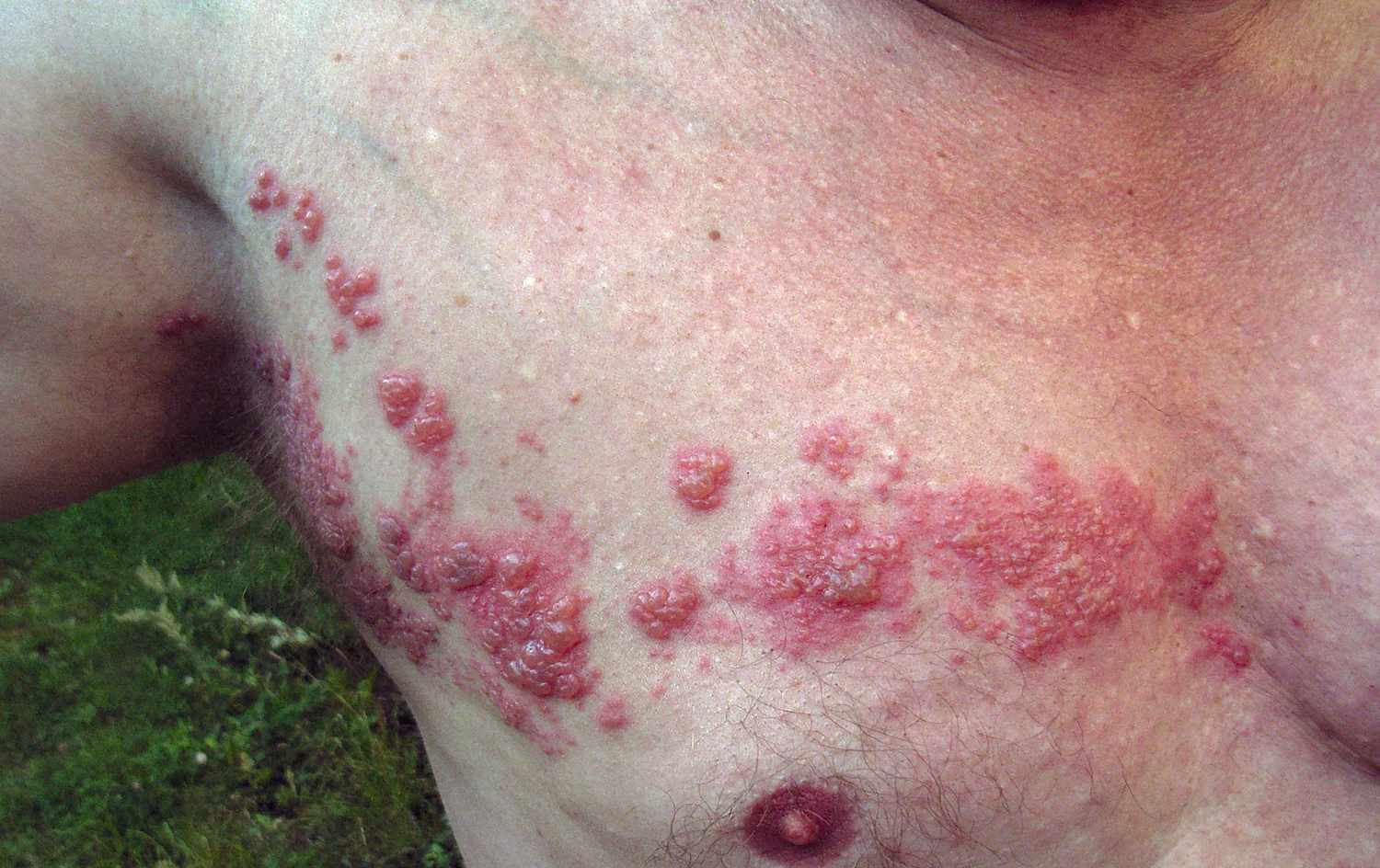 herpes zoster photos