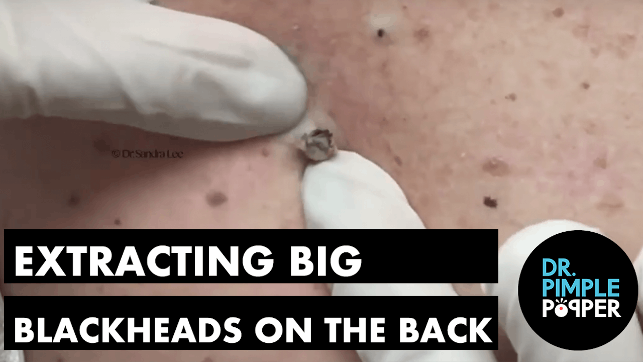 massive blackhead on back