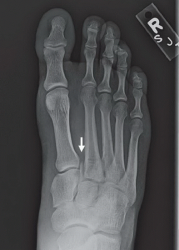 lisfranc fracture radiology