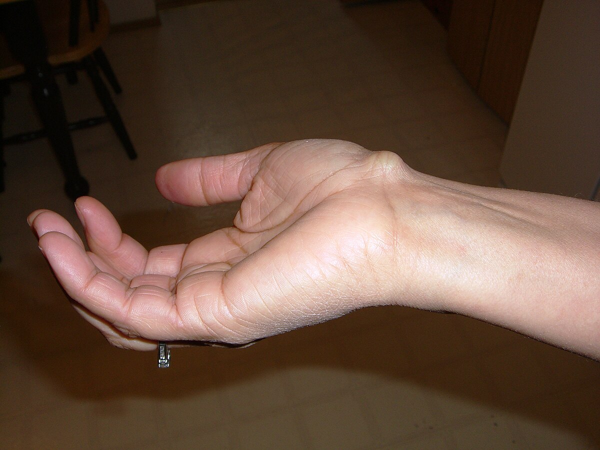 ganglion cyst icd 10