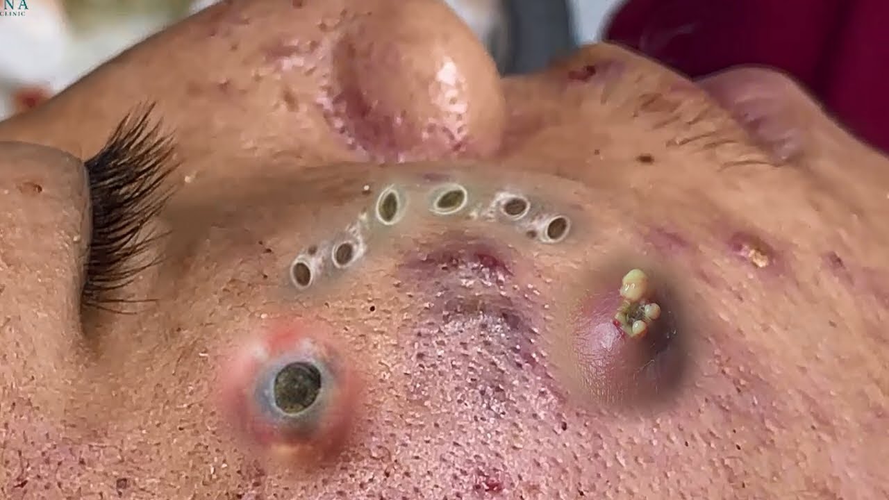 huge blackheads popped