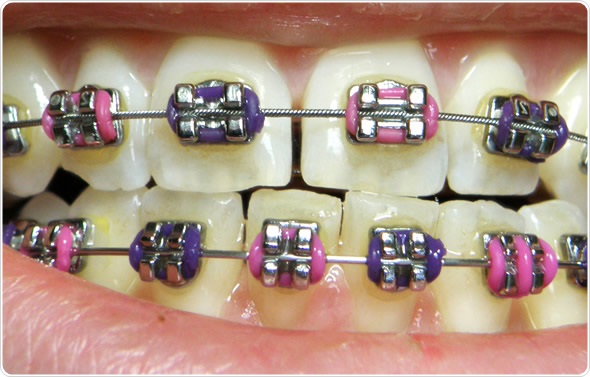 teeth braces images