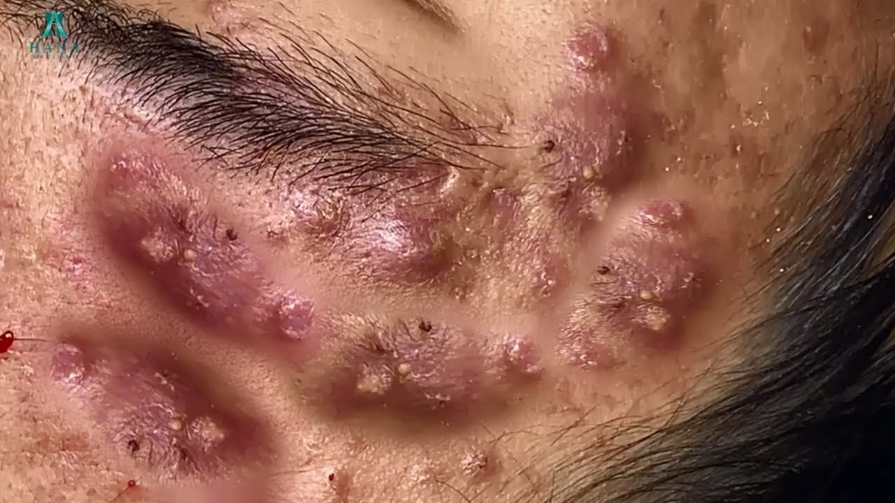 severe cystic acne popping