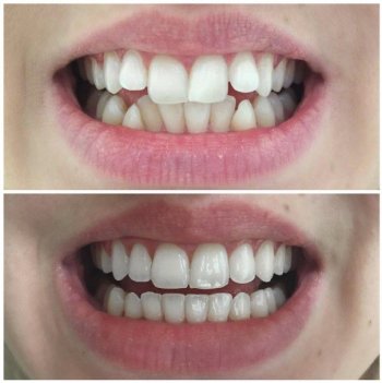 invisalign konya