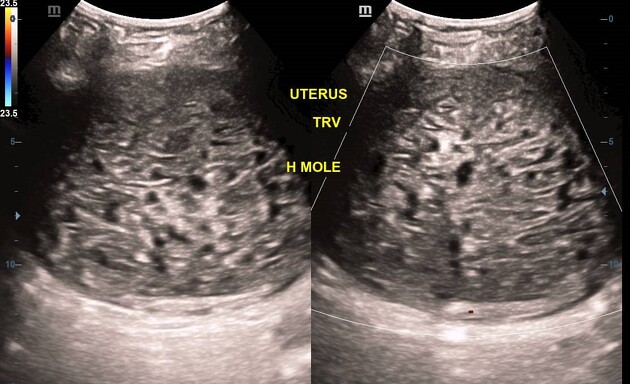 molar pregnancy radiology