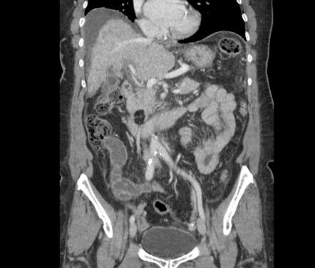 lipoma on pancreas