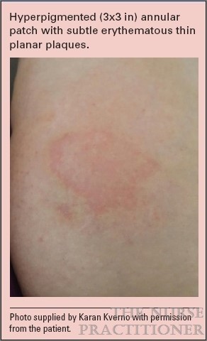 lamotrigine rash photos