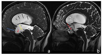 cerebral aqueduct stenosis