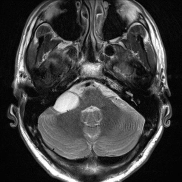 cerebellopontine angle cyst