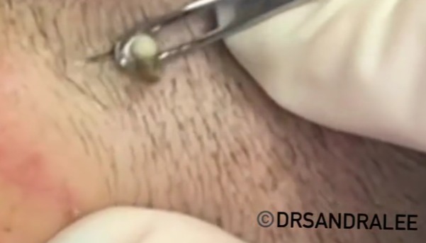 new dr pimple popper blackheads