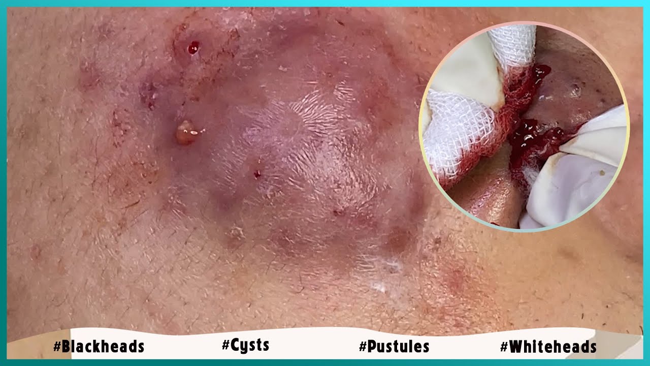 popping cystic acne