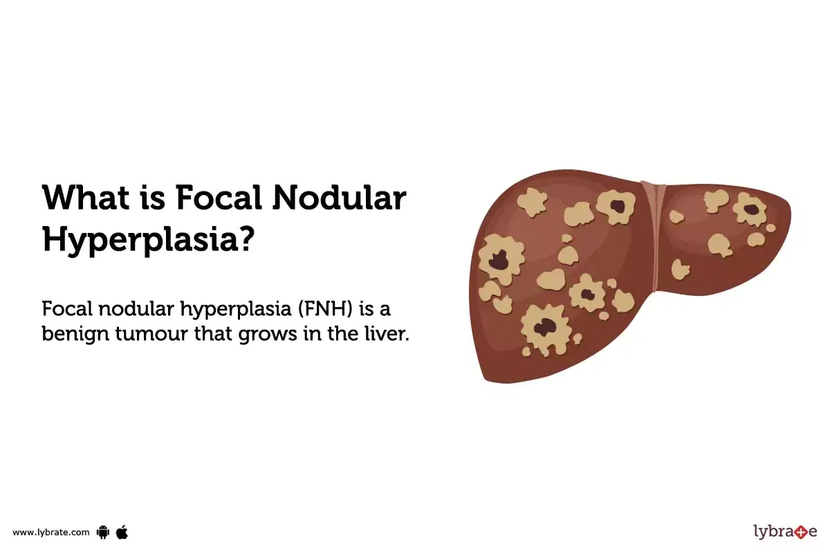 focal nodular hyperplasia liver