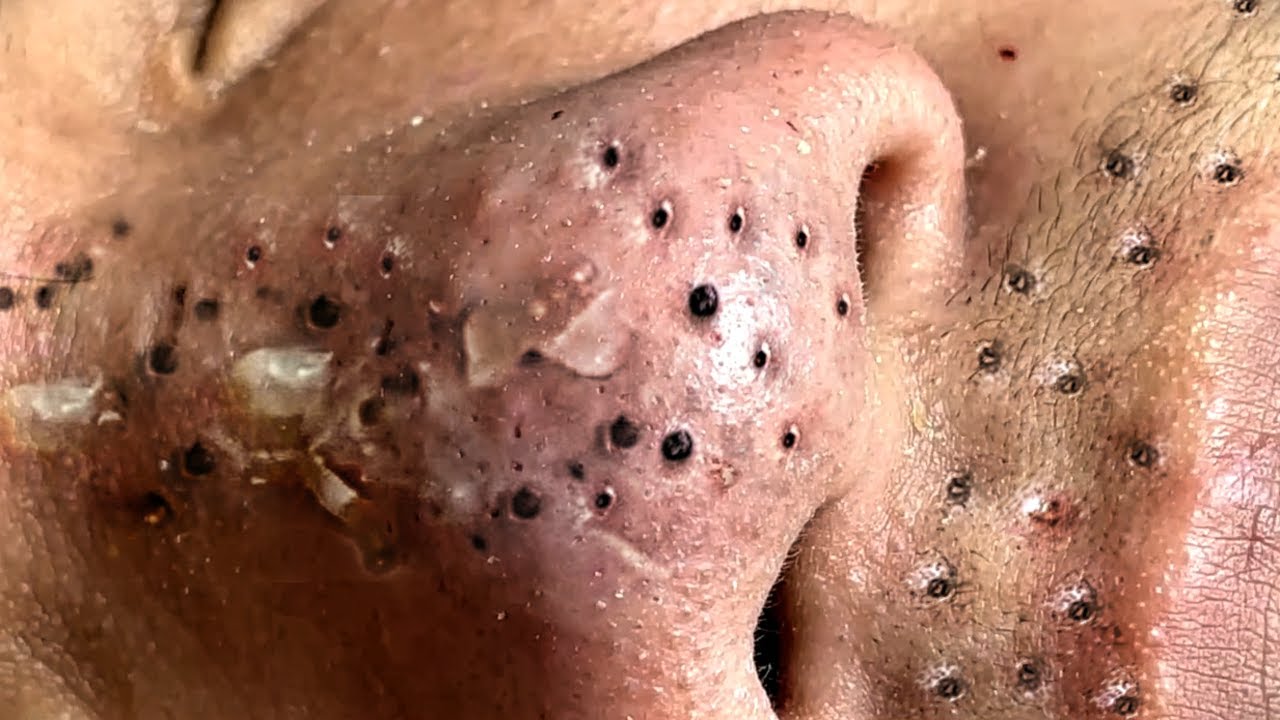 blackheads youtube