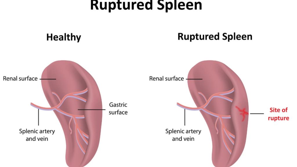 how long can you live with a ruptured spleen