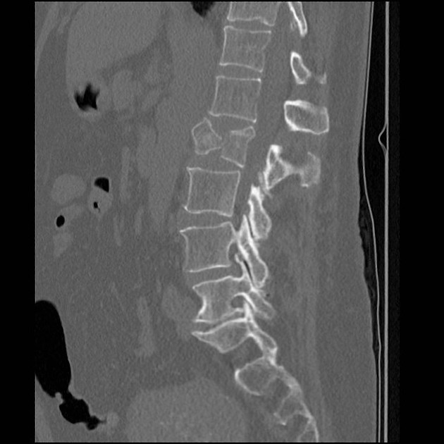 burst fracture radiology