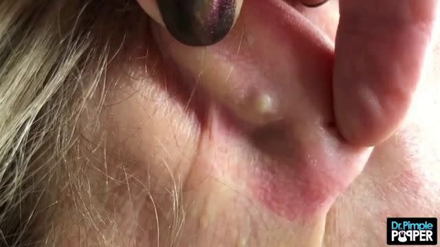 behind ear zit