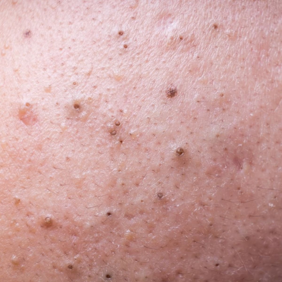 blackheads popped