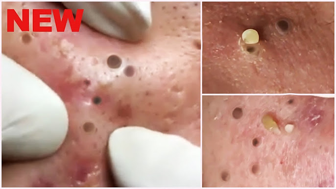 bubuplus blackhead removal 2018