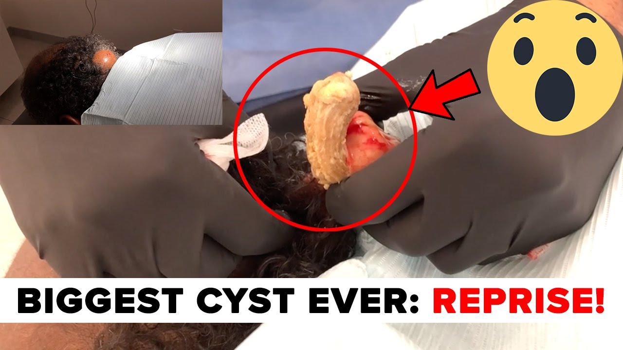 biggest cyst pop