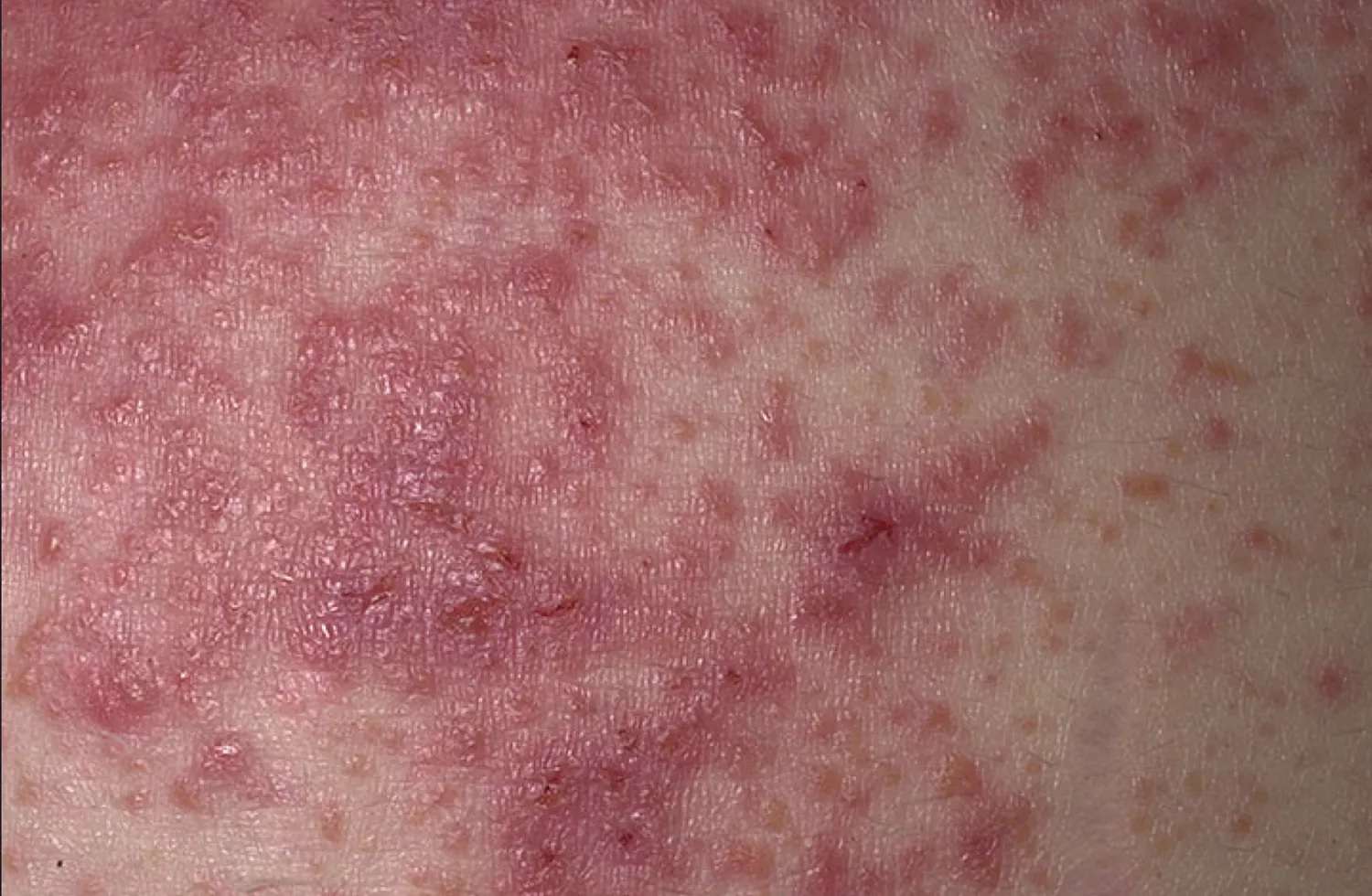coeliac disease rash photos