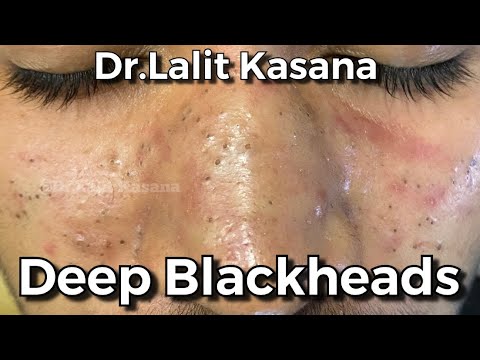 blackheads removal videos 2021