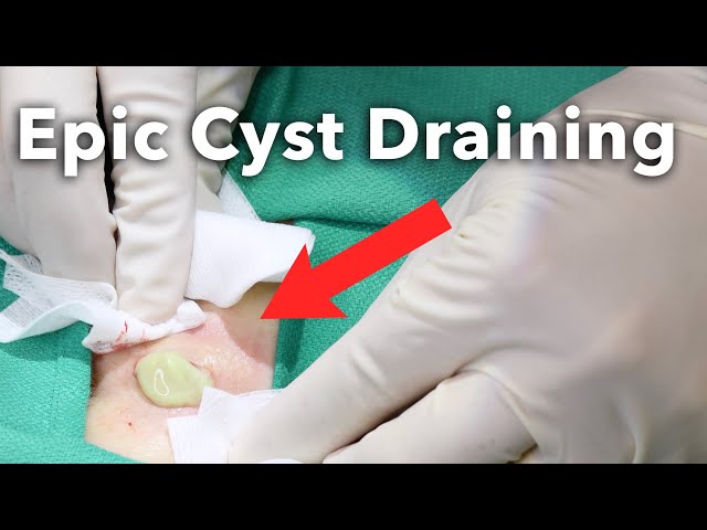 popped pilonidal cyst