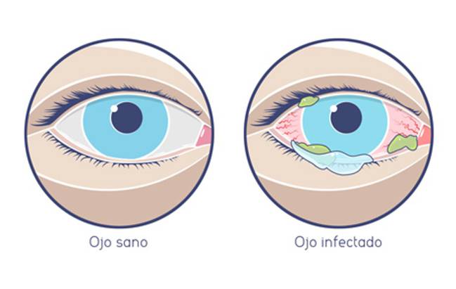 como se coge la conjuntivitis