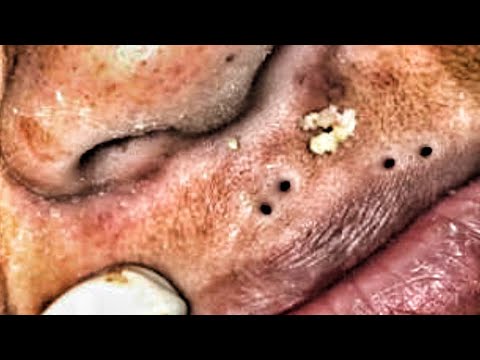 popping zits on youtube