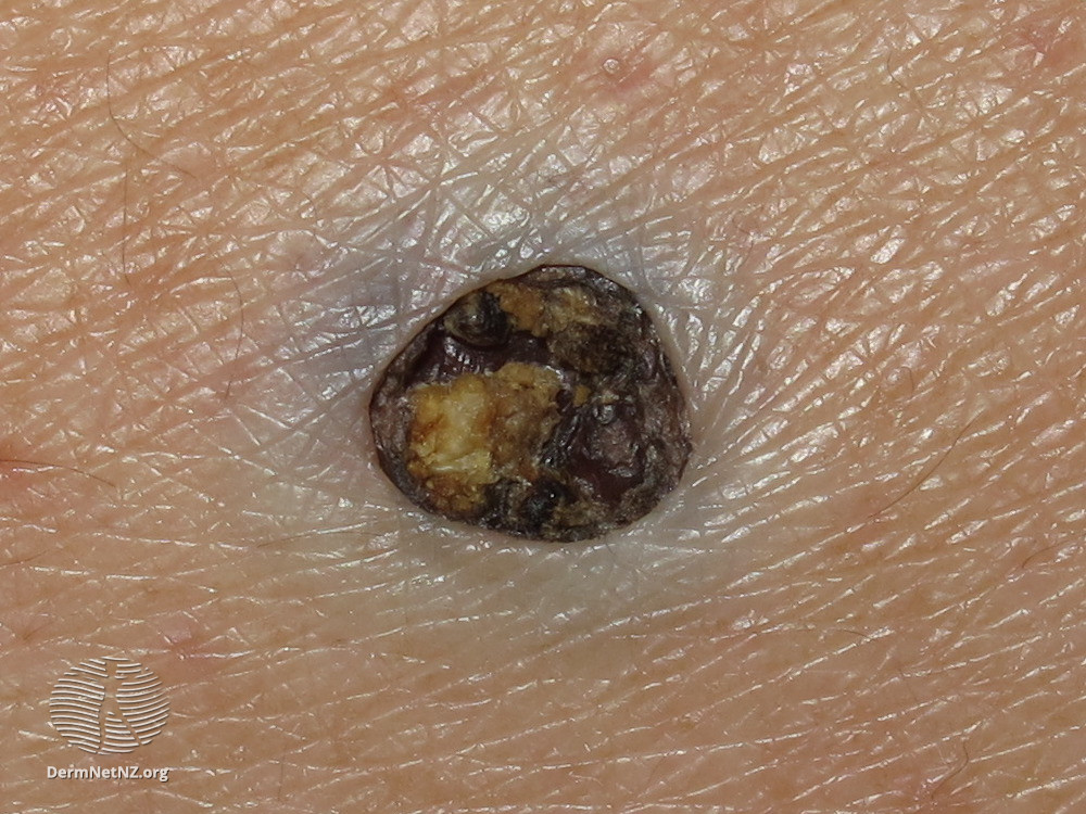 dilated pore of winer