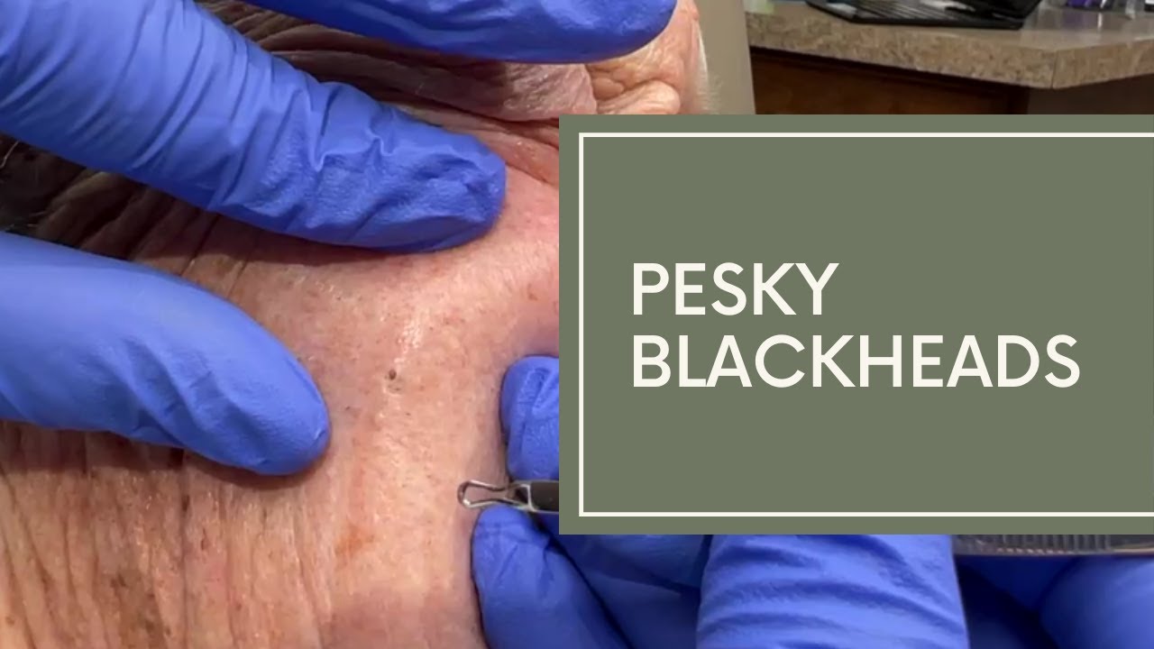 dr derm videos of squeezing blackheads