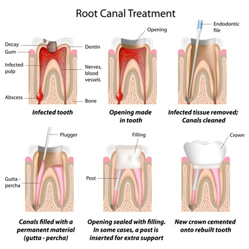 dental root canals services maple ridge