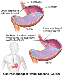 gastroesophageal reflux disease pronunciation