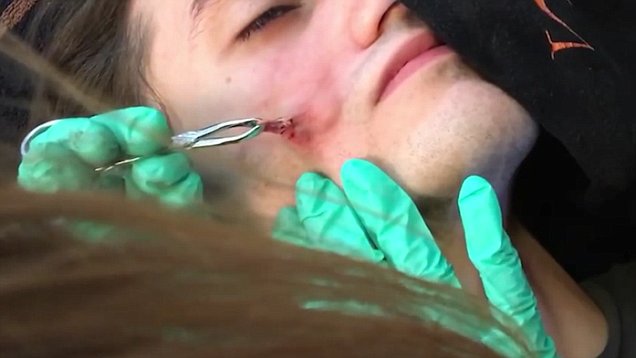 girl removing cyst from boyfriends face