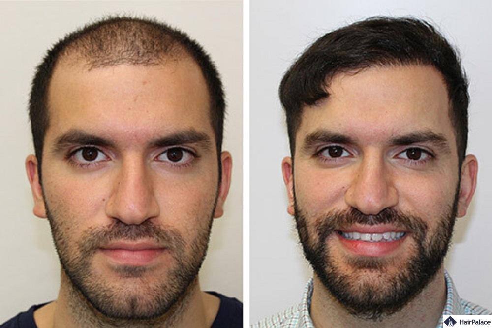 hair transplant frankfurt