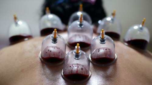 hijama near me