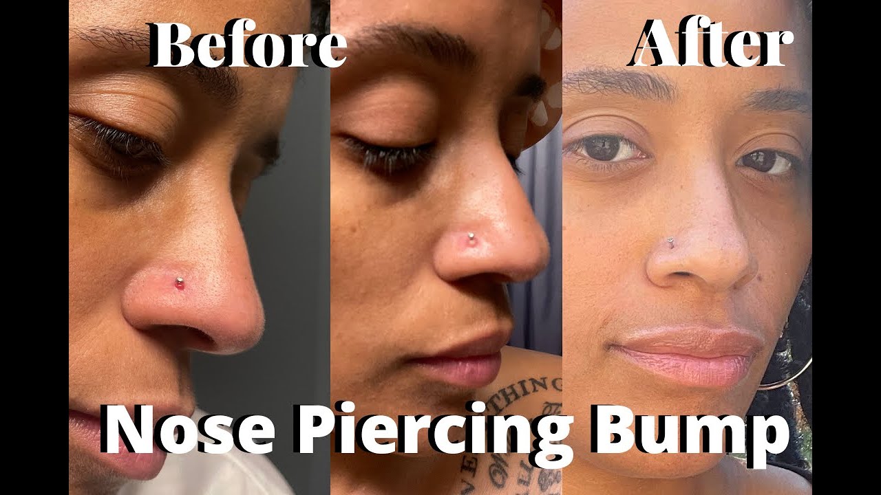 how to get rid of a piercing bump on nose