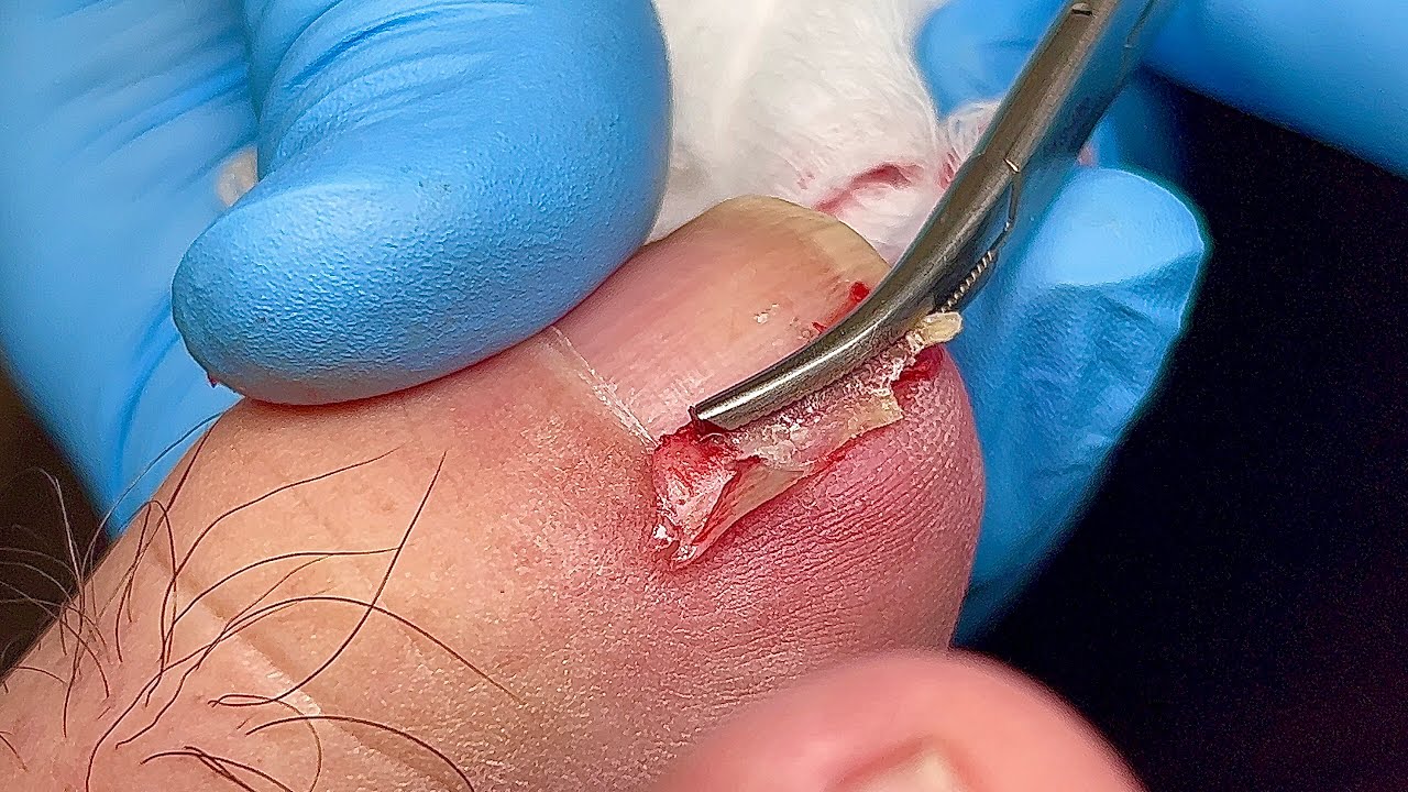 how to remove ingrown toenail youtube