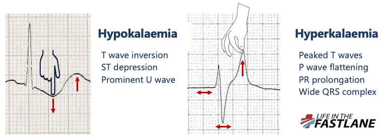 hyperkalemia ecg changes ati