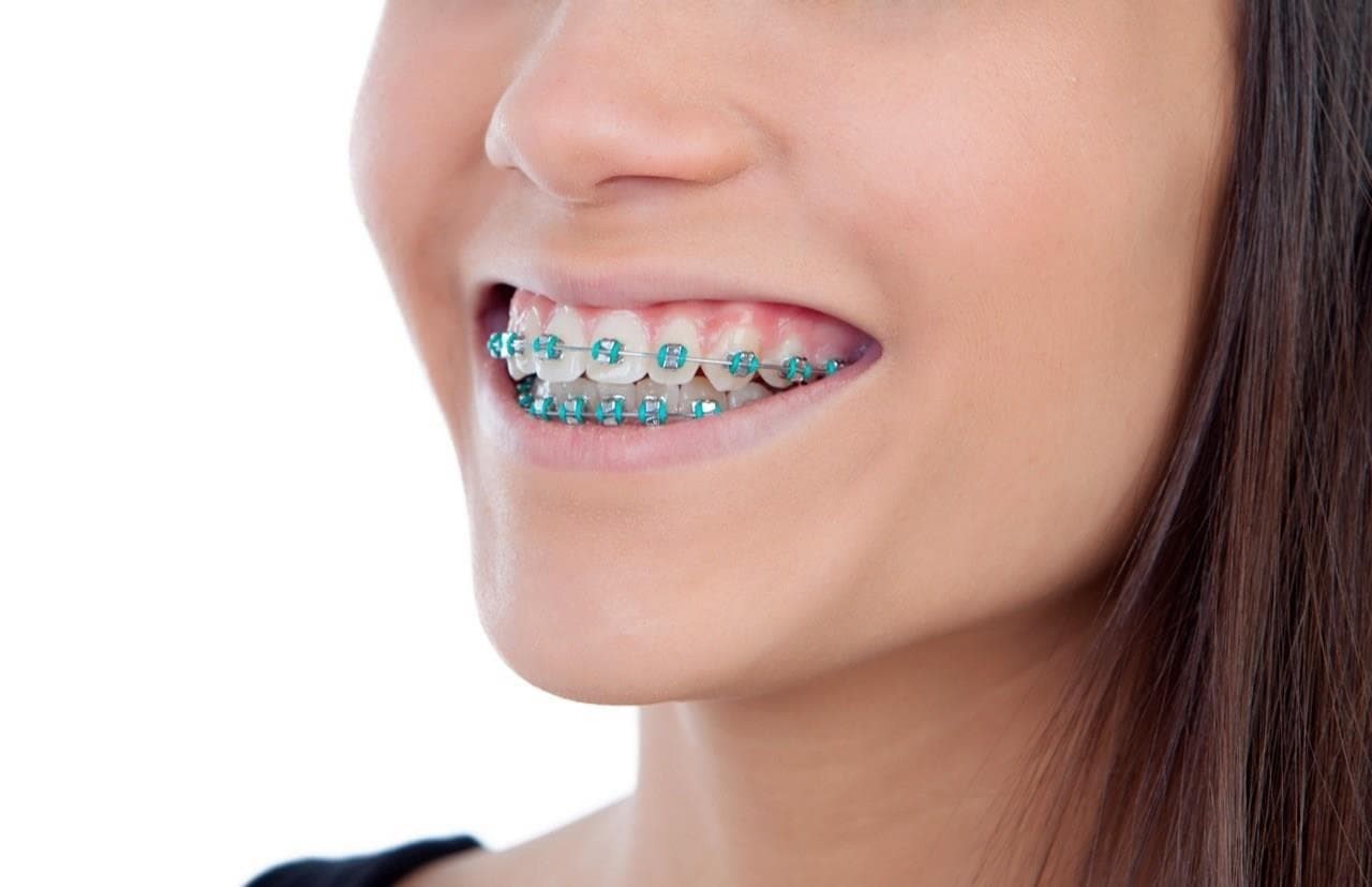 imagenes de brackets bonitos