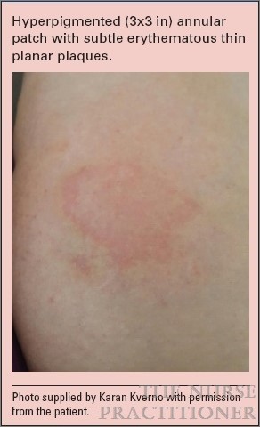 pictures of lamotrigine rash
