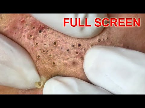 pimple popping videos on youtube